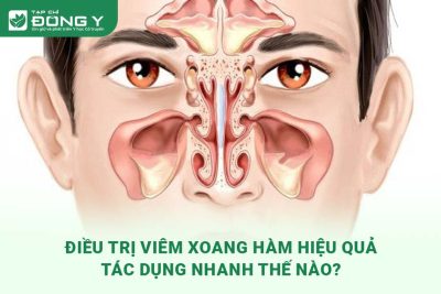 dieu-tri-viem-xoang-ham