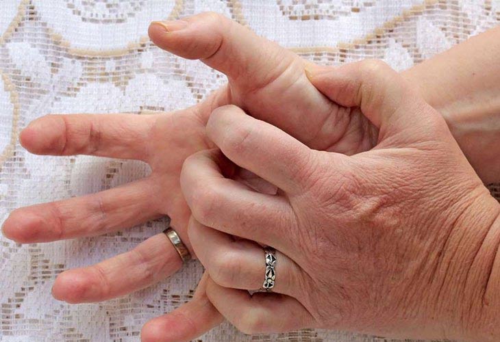 Mẩn ngứa lòng bàn tay do chàm tổ đỉa gây nên