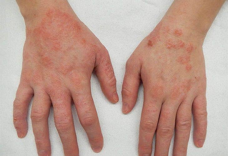 Viêm da cơ địa gây ngứa chân tay khó chịu, nổi nhiều nốt đỏ không đều nhau.