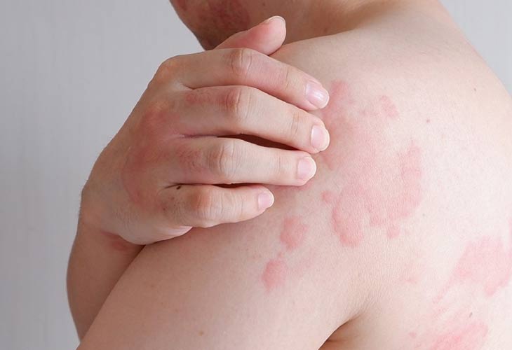 Nổi mề đay gây nổi mẩn ngứa thành mảng lớn trên tay