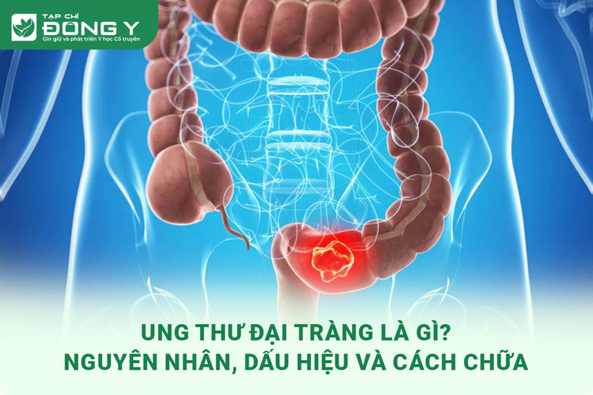 ung-thu-dai-trang