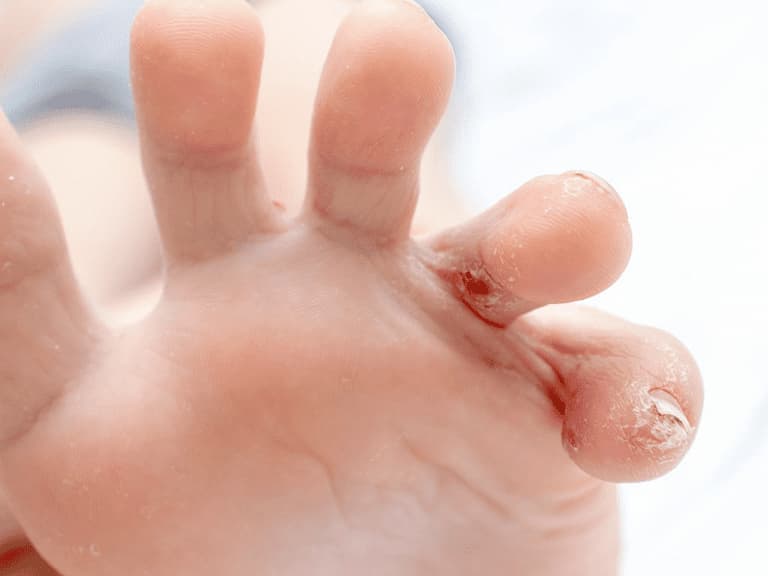 Những dấu hiệu đầu tiên của nhiêm trùng da ở chân