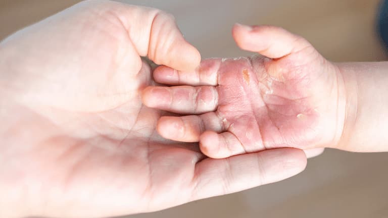 Bệnh tổ đỉa xuất hiện ở tay trẻ em với những vết bong tróc 