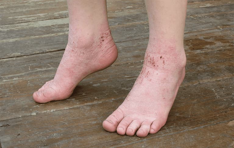 Những vết gãi ngứa rướm máu ở chân 