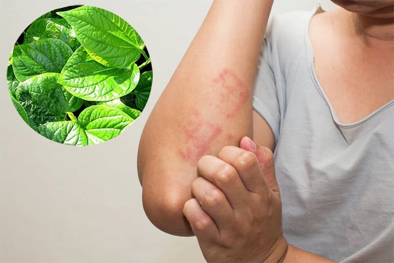 Mẹo dùng lá trầu không để chữa bệnh viêm da cơ địa á sừng là bài thuốc dân gian