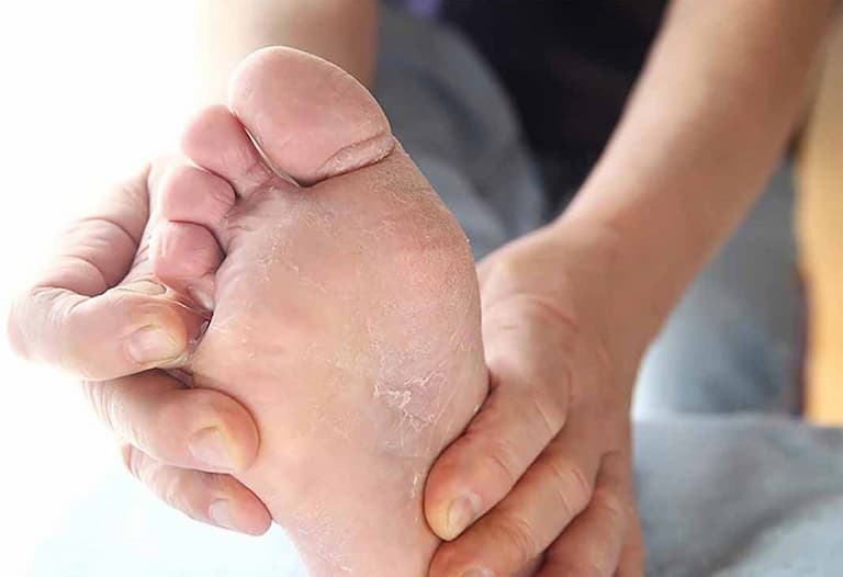 Những vết nứt ở lòng bàn chân khiến bệnh nhân khó chịu và ngứa ngáy