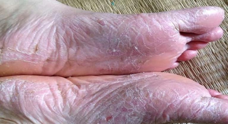 Bàn chân nứt nẻ và tróc vảy trắng của người bệnh mắc viêm da cơ địa á sừng
