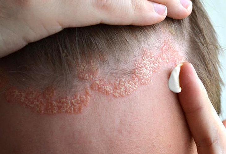 Viêm da tiết bã nhờn gây tình trạng ngứa da, bong tróc vảy