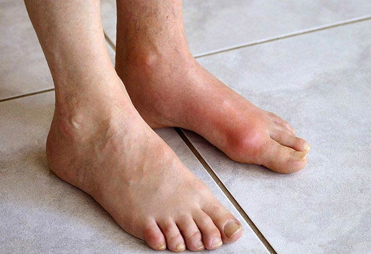 gout-man-tinh