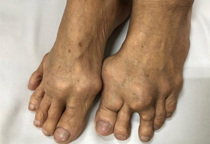 gout-man-tinh