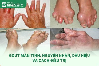 gout-man-tinh