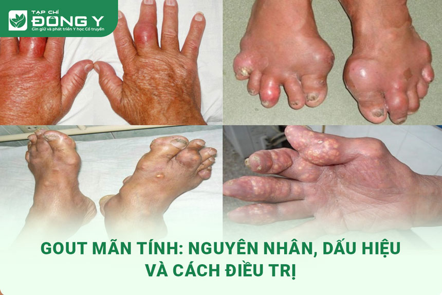 gout-man-tinh