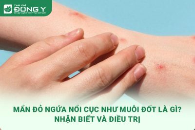 man-do-ngua-noi-cuc-nhu-muoi-dot