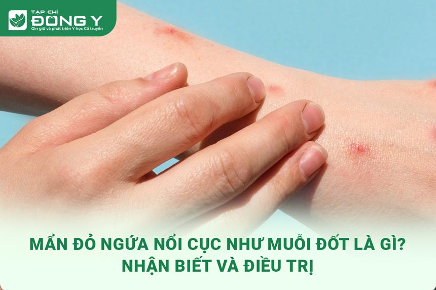 man-do-ngua-noi-cuc-nhu-muoi-dot