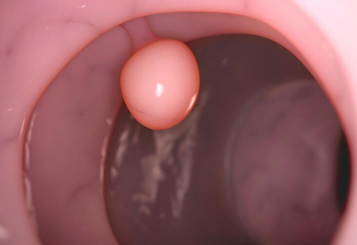 polyp-dai-trang-o-tre-em