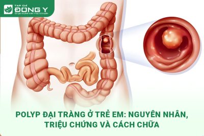 polyp-dai-trang-o-tre-em