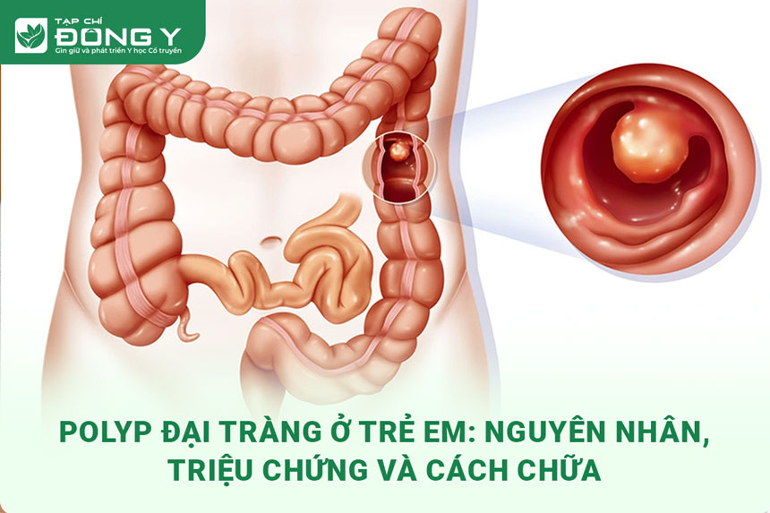 polyp-dai-trang-o-tre-em