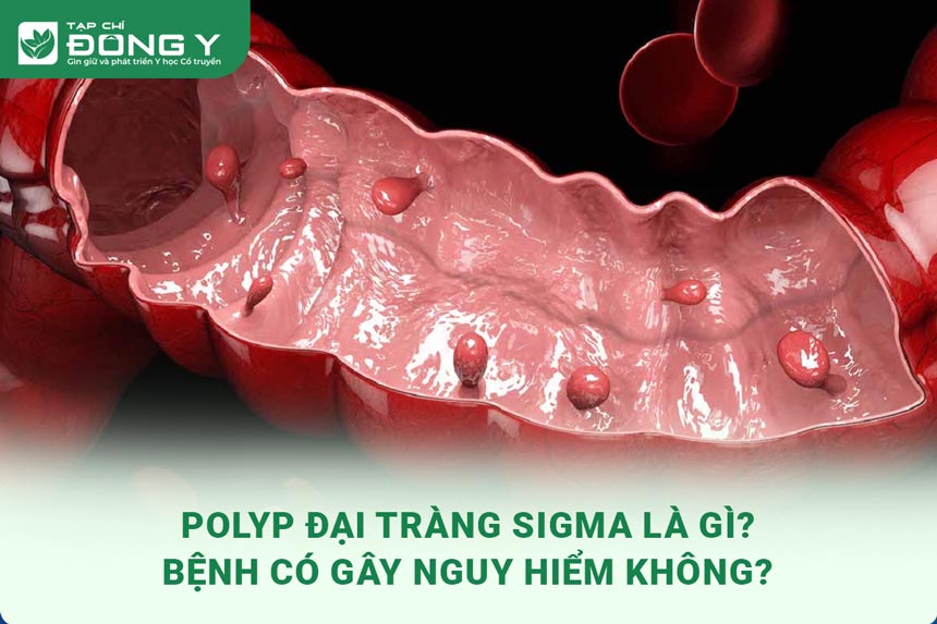 polyp-dai-trang-sigma