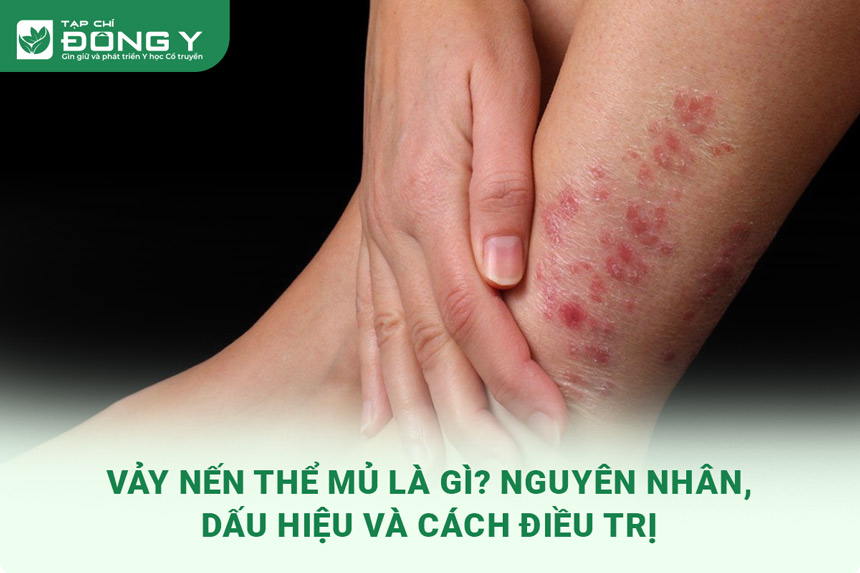 vay-nen-the-mu