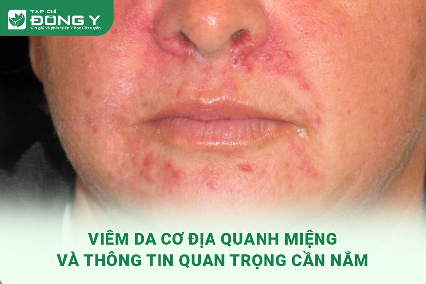viem-da-co-dia-quanh-mieng