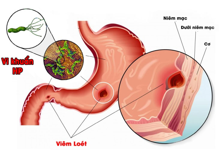 viem-da-day-man-tinh