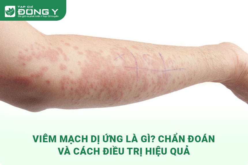 viem-mach-di-ung