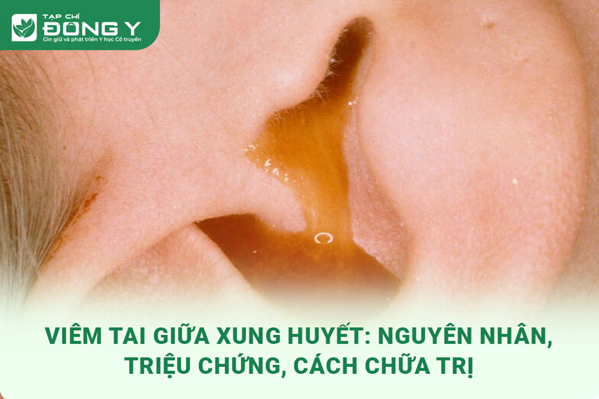 viem-tai-giua-xung-huyet