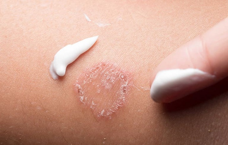 Kem trị viêm da cơ địa của Nga hiện đang được nhiều người bệnh tin dùng Kem trị viêm da cơ địa của Nga hiện đang được nhiều người bệnh tin dùng