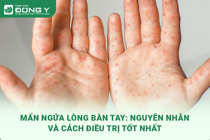 man-ngua-long-ban-tay