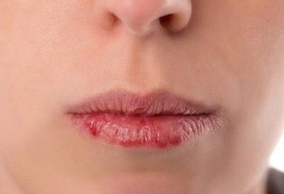 Ngứa môi do viêm da dị ứng