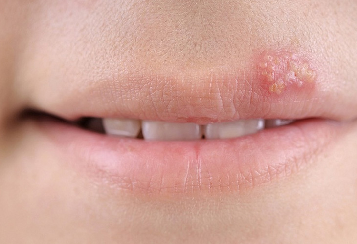 Bệnh herpes được xác định là một trong những nguyên nhân gây bệnh