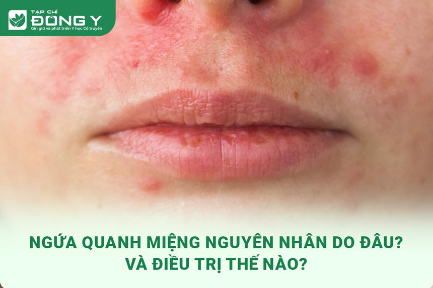 ngua-quanh-mieng