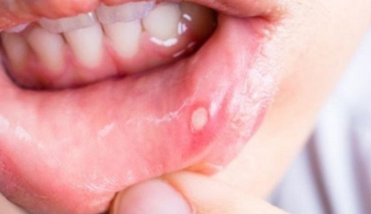 Bị nhiệt miệng bôi gì là vấn đề được nhiều người quan tâm