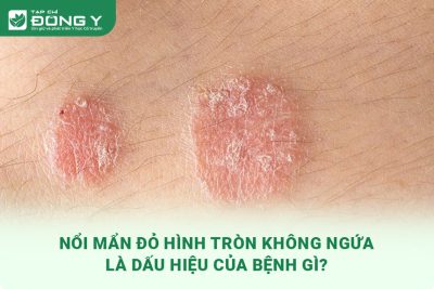 noi-man-do-hinh-tron-khong-ngua