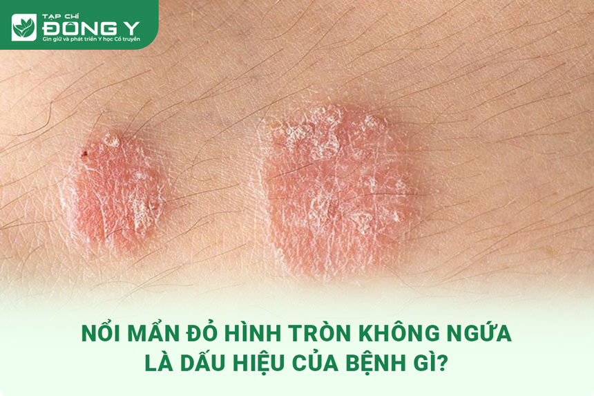 noi-man-do-hinh-tron-khong-ngua