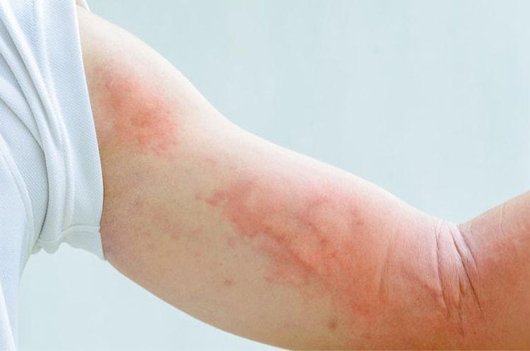 Nổi mề đay có phải kiêng gió không?
