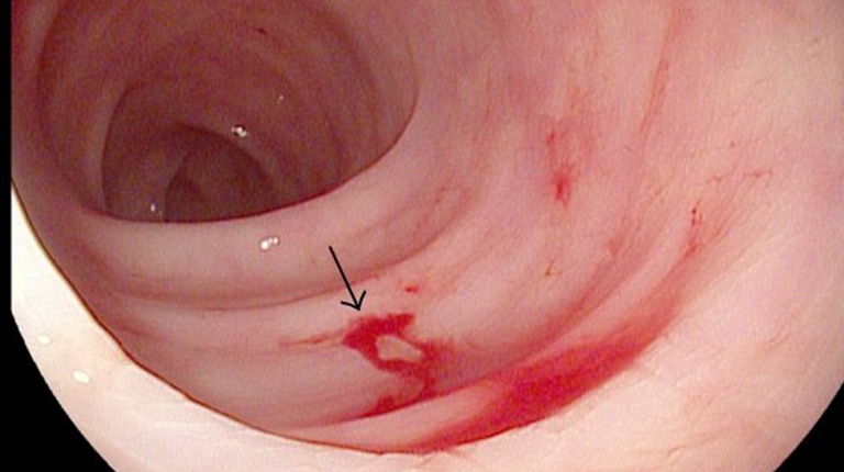 Xuất huyết trực tràng là triệu chứng phổ biến nhất của polyp đại tràng sigma