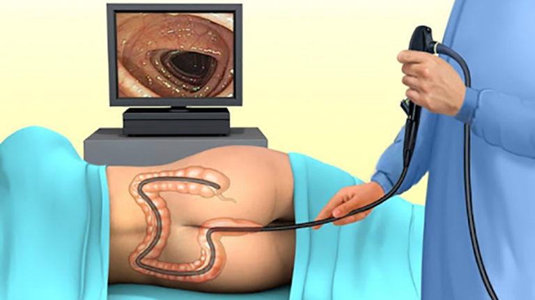 Nội soi đại tràng là phương pháp chính xác nhất để phát hiện polyp đại tràng sigma