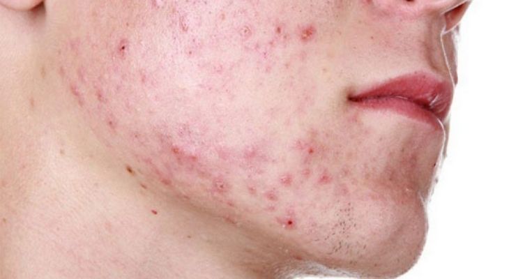 Rối loạn nội tiết tố có gây mụn