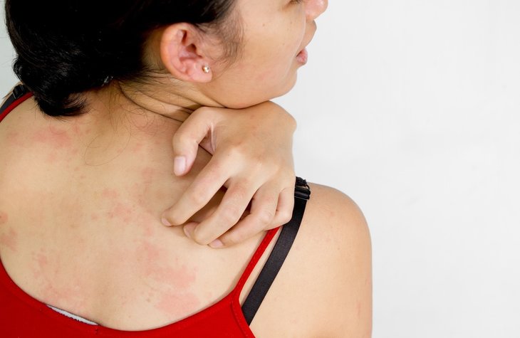 Thuốc trị mề đay Nhật Bản nào tốt? Thuốc trị mề đay Nhật Bản nào tốt?