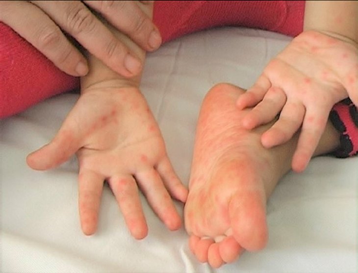 Bé nổi mẩn ngứa khắp người sau sốt có thể do bệnh chân tay miệng