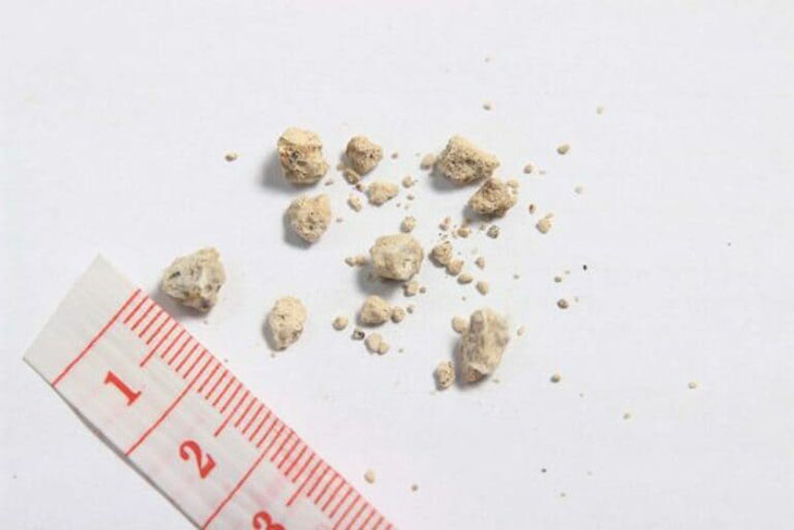 Sỏi thận 9mm chưa cần thiết phải mổ