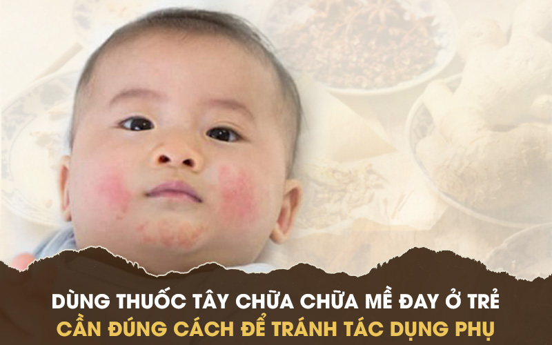 Thận trọng khi dùng thuốc Tây chữa mề đay cho bé