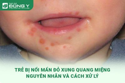 tre-bi-noi-man-do-xung-quanh-mieng