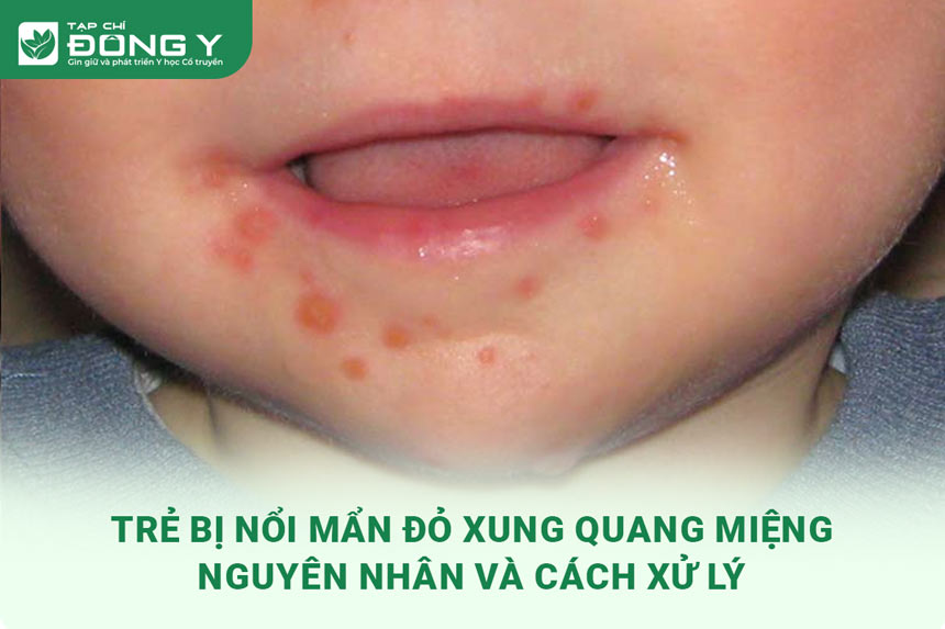 tre-bi-noi-man-do-xung-quanh-mieng