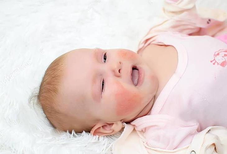 Viêm da cơ địa là căn bệnh da liễu thường gặp ở trẻ nhỏ