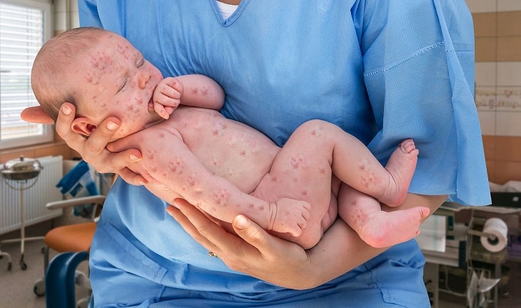 Hình ảnh trẻ sơ sinh bị bệnh sởi nổi mẩn đỏ khắp người, gồm cả chân và tay