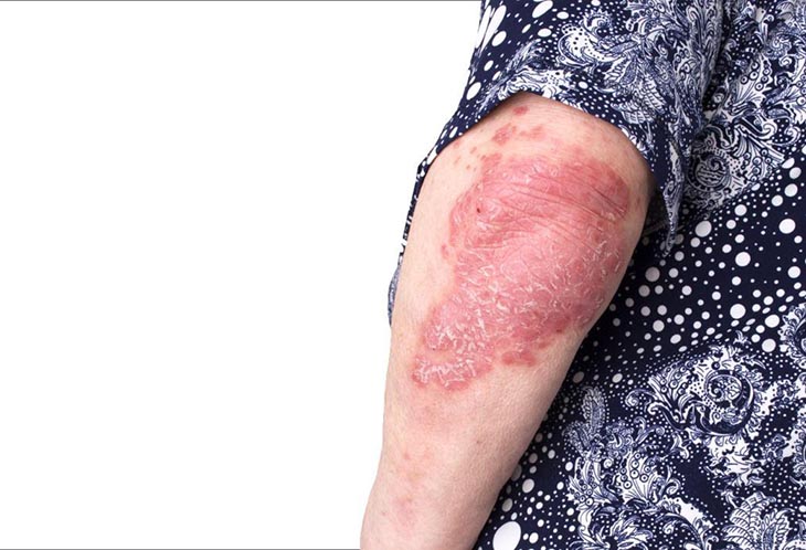 Vảy nến thể khớp là một trong những bệnh khó điều trị