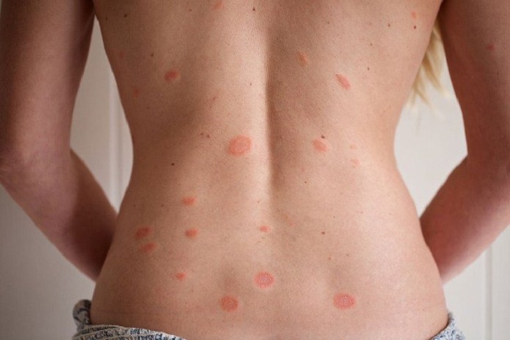 Vảy phấn hồng bao lâu thì khỏi