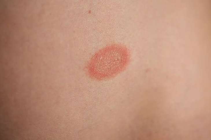 Vảy phấn hồng là một căn bệnh da liễu gây ngứa ngáy, khó chịu
